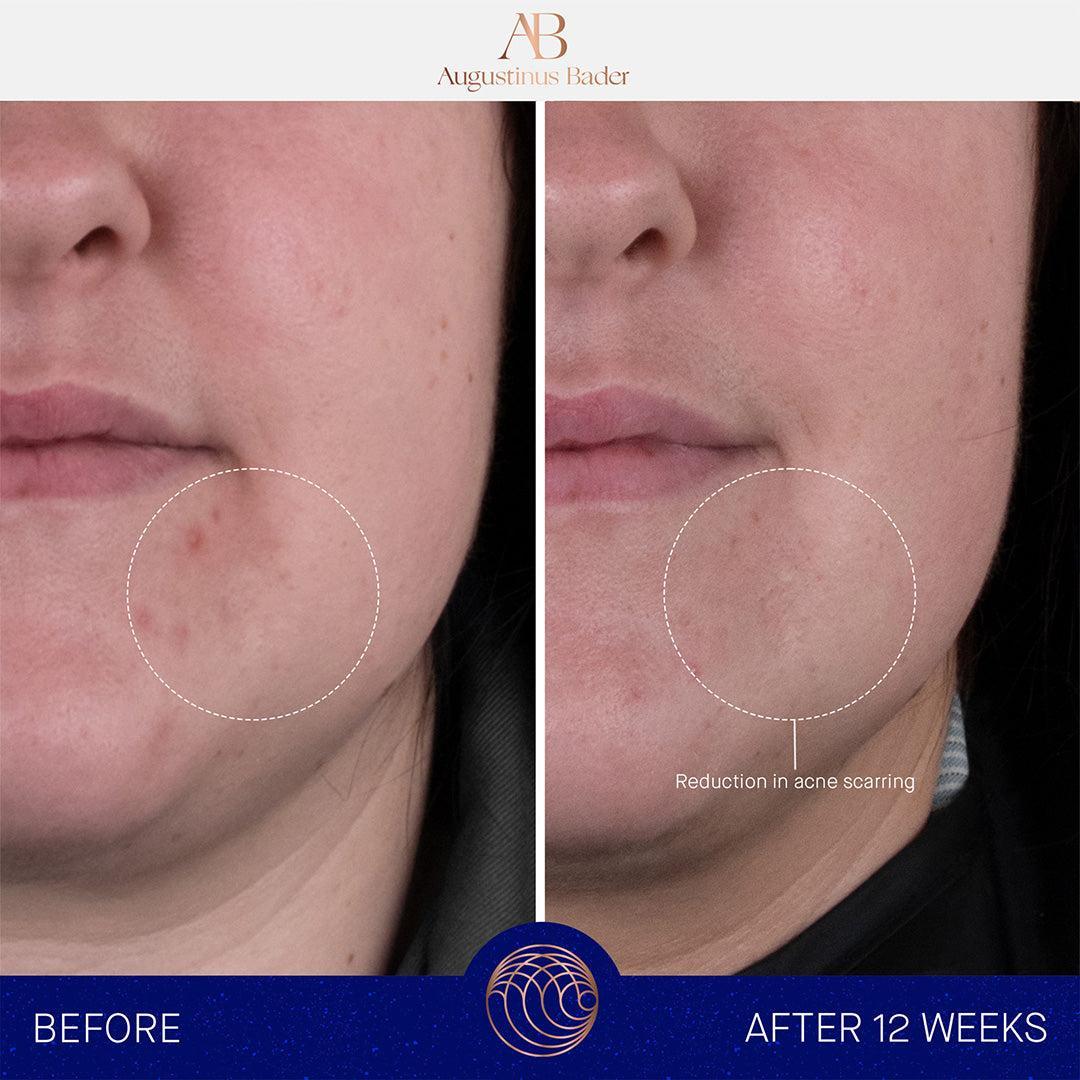 Augustinus Bader The Rich Cream-Lotion & Moisturizer-Augustinus Bader-Leigh Kelley Skin Studio Best Facialist Hudson Valley Kingston New York