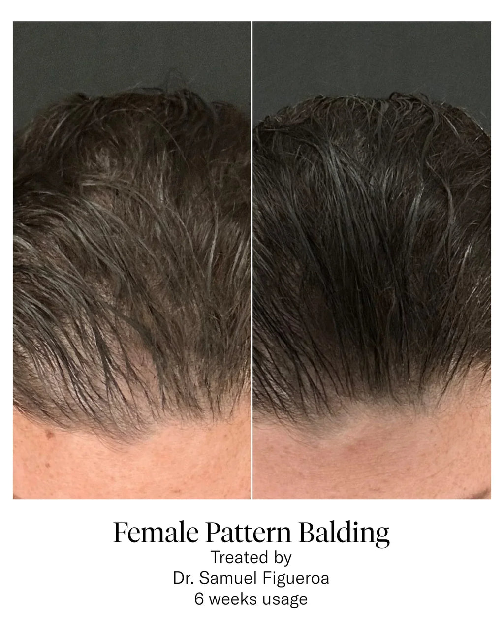 Calecim Advanced Hair System