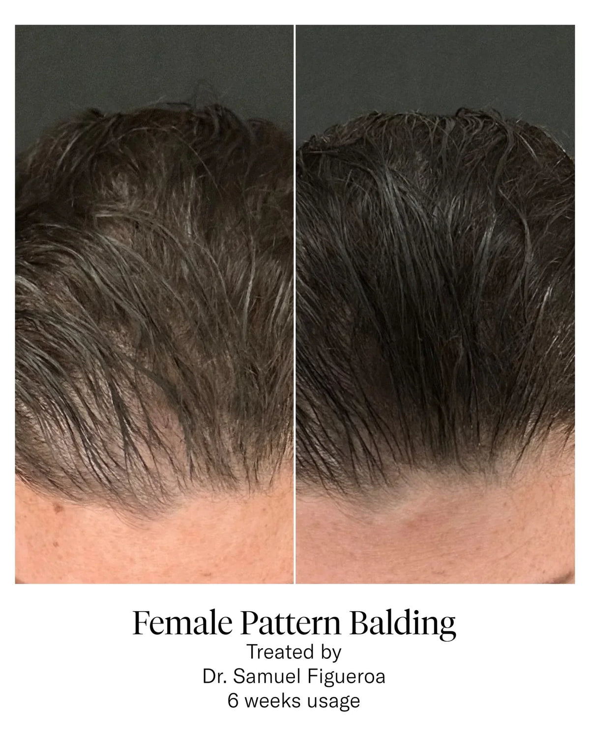 Calecim Advanced Hair System
