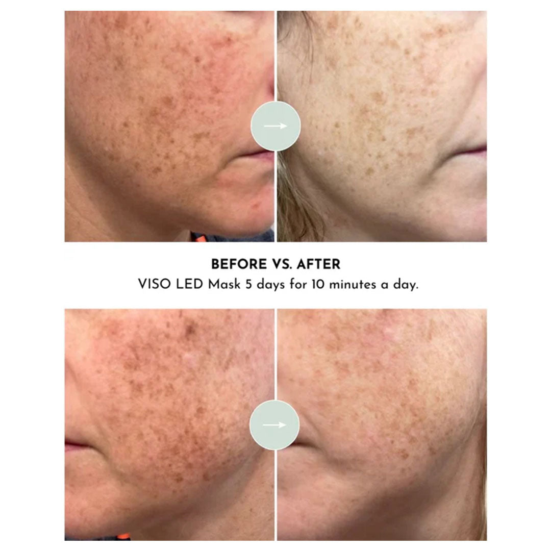 VISO Anti Aging Red Light Mask